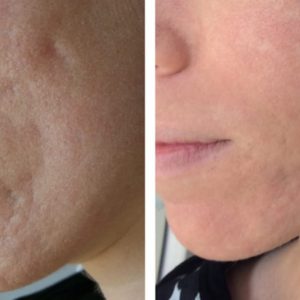Laser Acne and Acne Scar Treatment