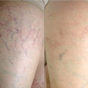 Spiderveins Removal